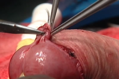 Наложение швов на внутренний и наружный листки полового члена