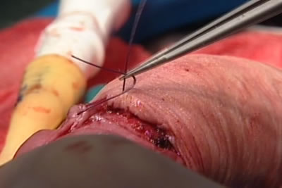 Наложение швов на внутренний и наружный листки полового члена