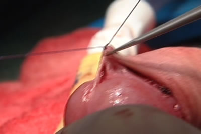 Наложение швов на внутренний и наружный листки полового члена