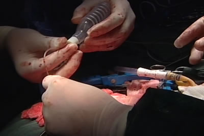 Установка активной аспирации по дренажу