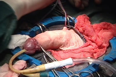 Окончательный вид полового члена