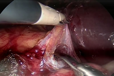 Выделение почки