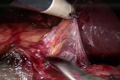 Выделение почки