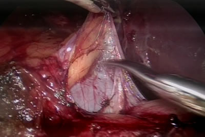 Выделение почки