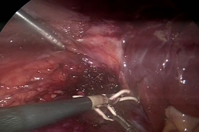 Накладывание на сосудистую (артериальную) ножку почки резиновой держалки, что бы в последующем прежать почечную артерию и остановить кровоток для "сухой" резекции почки