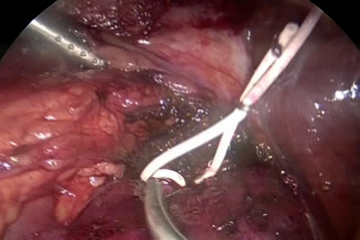 Резиновая держалка наложена на почечную артерию и фиксирована клипсой