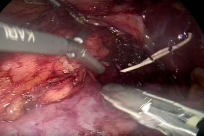 Этап выделения почечной артерии