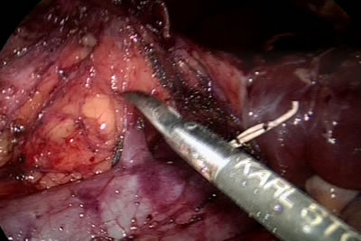 Этап выделения почечной артерии