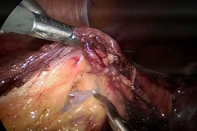 Выделение почки из паранефральной клетчатки