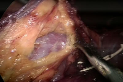 Выделение почки из паранефральной клетчатки