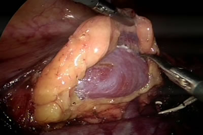 Выделение почки из паранефральной клетчатки