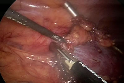 Использование аппарата LigaSure для быстрого и бескровного выделения почки