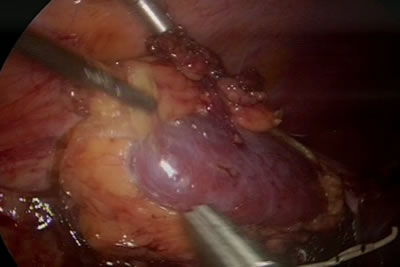 Выделена передняя поверхность и нижний полюс правой почки