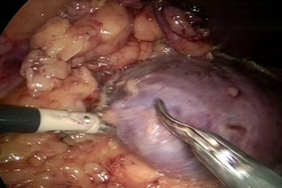 Дальнейшее выделение нижнего полюся почки