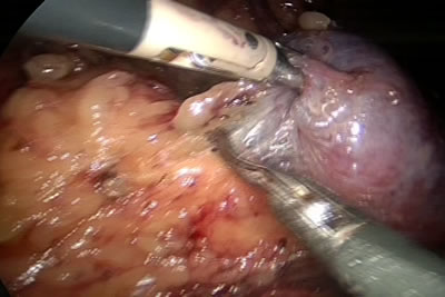 Выделение задней поверхности почки