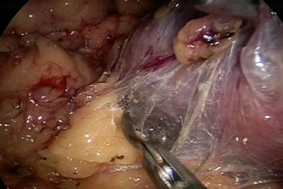 Выделение задней поверхности почки