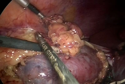 В месте прилегания жировой клетчакти к опухоли почки накладывается клипса для того, что бы патологи смогли более тщательно изучить структур тканей на предмет наличия раковых клеток