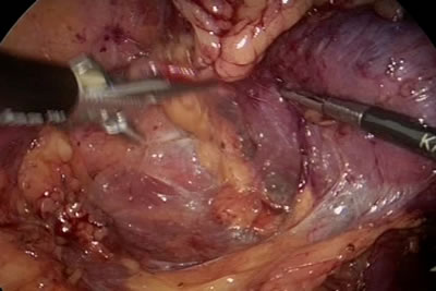 В месте прилегания жировой клетчакти к опухоли почки накладывается клипса для того, что бы патологи смогли более тщательно изучить структур тканей на предмет наличия раковых клеток