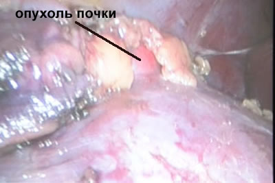Видна опухоль почки с прилегающей к ней паранефральной клетчаткой