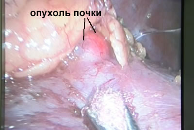 Видна опухоль почки с прилегающей к ней паранефральной клетчаткой