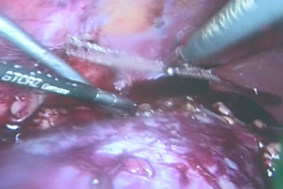 Для "армирования" тканей почки на дно резецированной поверхности почки укладывается полипропиленовая сетка