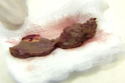 Макропрепарат удаленной опухоли почки