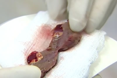 Макропрепарат удаленной опухоли почки. Видна ткань опухоли желтого цвета