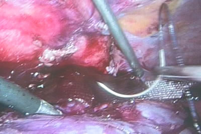 Этап ушивания почки