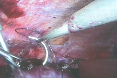 Этап ушивания почки