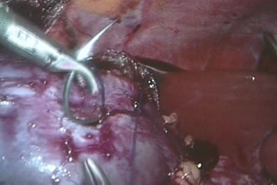 Этап ушивания почки