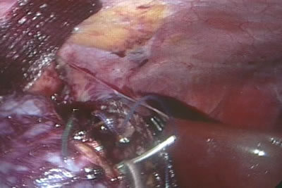 Этап ушивания почки