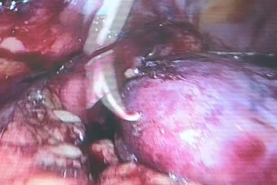 С почечной артерии срезана резиновая держалка и кровоток восстановлен