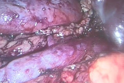 Окончательный гемостаз, ревизия, дренирование, удаление портов, ушивание ран передней брюшной стенки