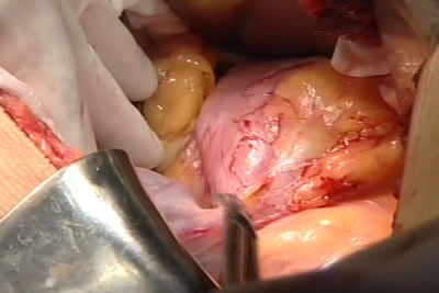 Из-за хронического калькулезного холецистита в брюшной полости имеется спаечный процесс