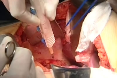 Рассечение спаек брюшной полости