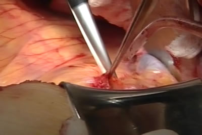 Вскытие париетальной брюшины для доступа к забрюшинном пространству, почке