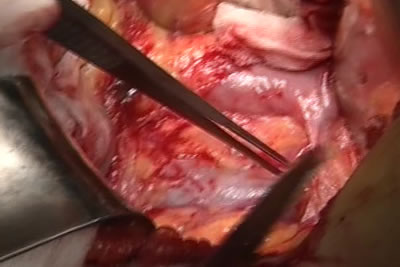 Париетальная брюшина вскрыта видна нижняя полая вена