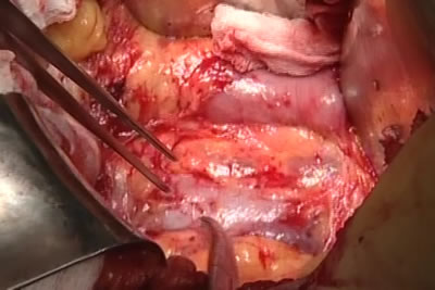 Идет выделение сосудистой ножки почки