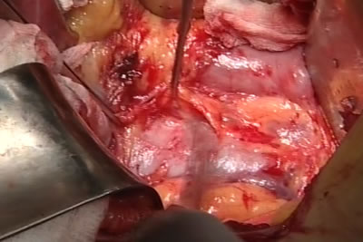 Идет выделение сосудистой ножки почки