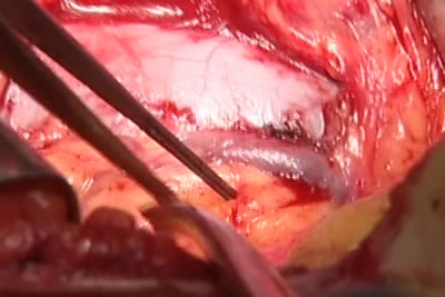 Идет выделение сосудистой ножки почки