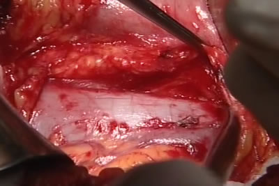 Идет выделение сосудистой ножки почки