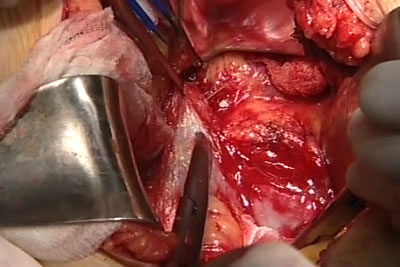 Идет выделение сосудистой ножки почки