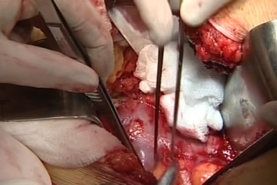 На фото видна нижня полая вена и, отходящая от нее, правая почечная вена