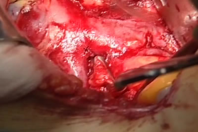 На фото видна нижня полая вена и, отходящая от нее, правая почечная вена