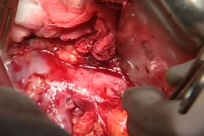 На фото видна нижня полая вена и, отходящая от нее, правая почечная вена