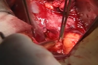 Выделение сосудистой ножки почки