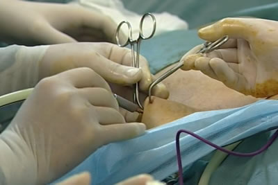 Наполнение брюшной полости воздухом