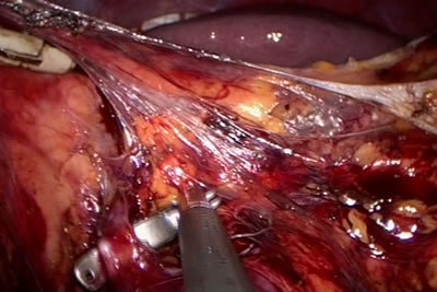 Специальным инструметом взят сосуд