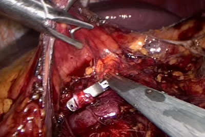 Накладывается клипса на сосуд