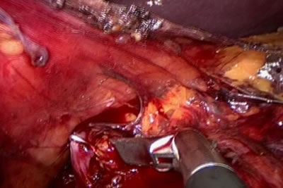 Наложена клипса на сосуд